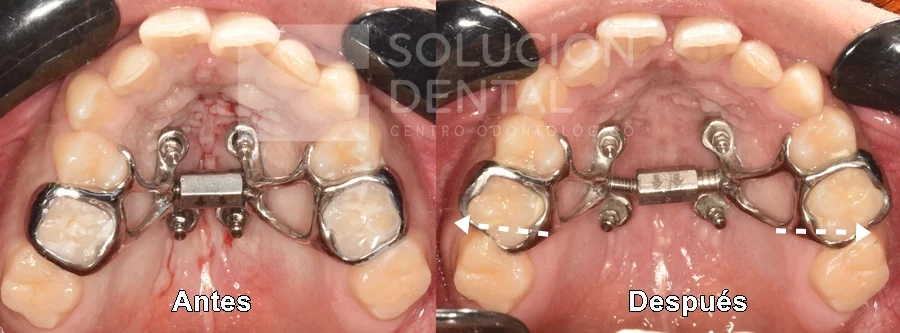 Expansion maxilar MARPE Lima Perú