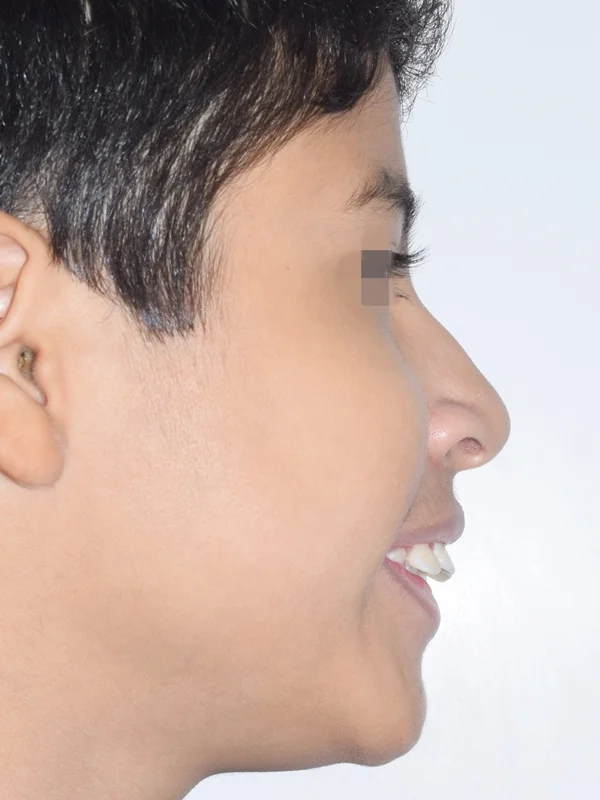 Dientes salidos antes peru