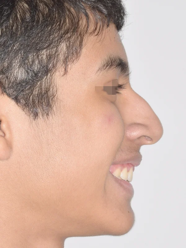 Dientes salidos después peru