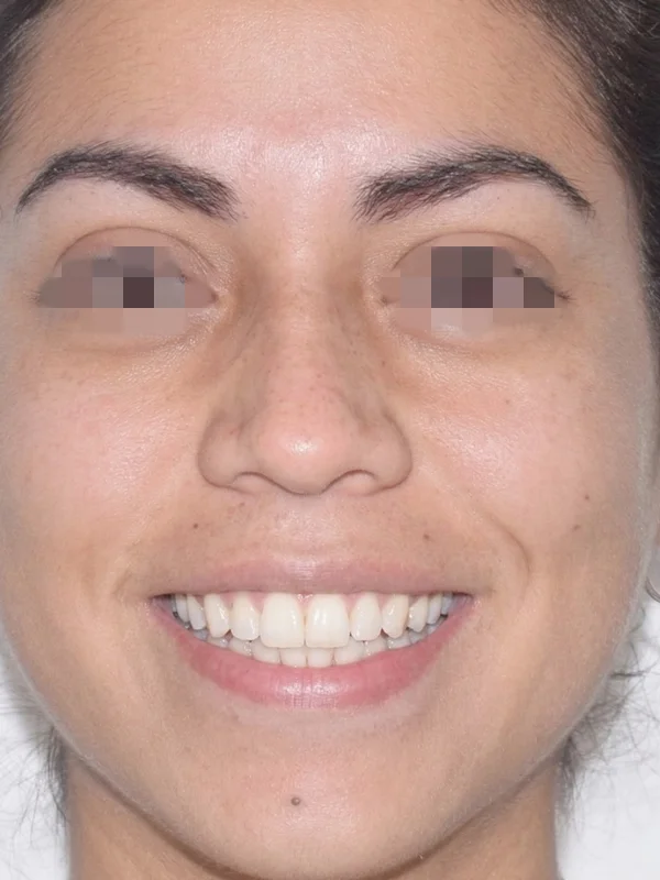 Brackets Despues