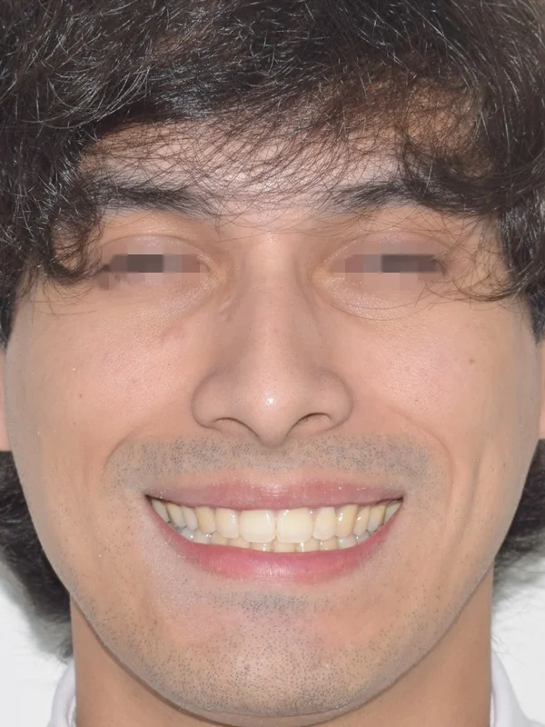 Despues de Brackets