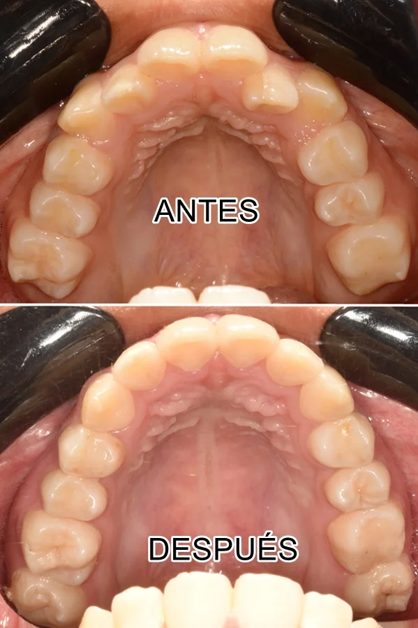 antes-despues-ortodoncia-DIENTES OCLUSAL-sonrisa-expansion-maxilar