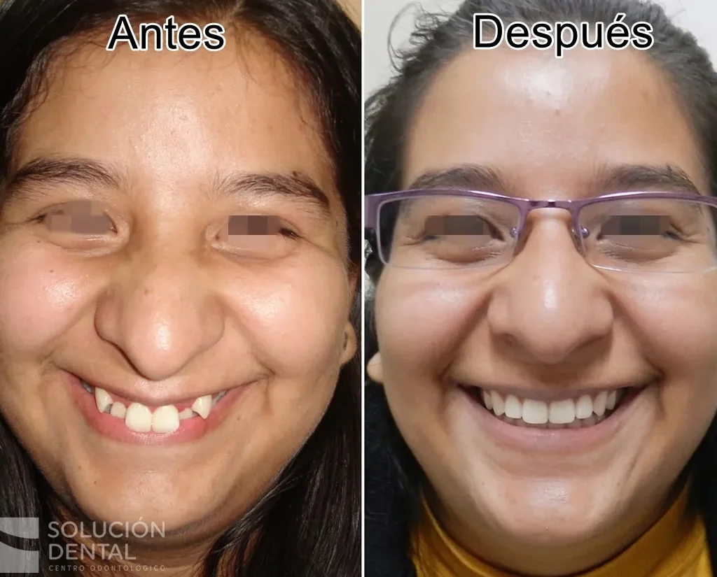 cambio-forma-de-cara-ortodoncia-lima-peru