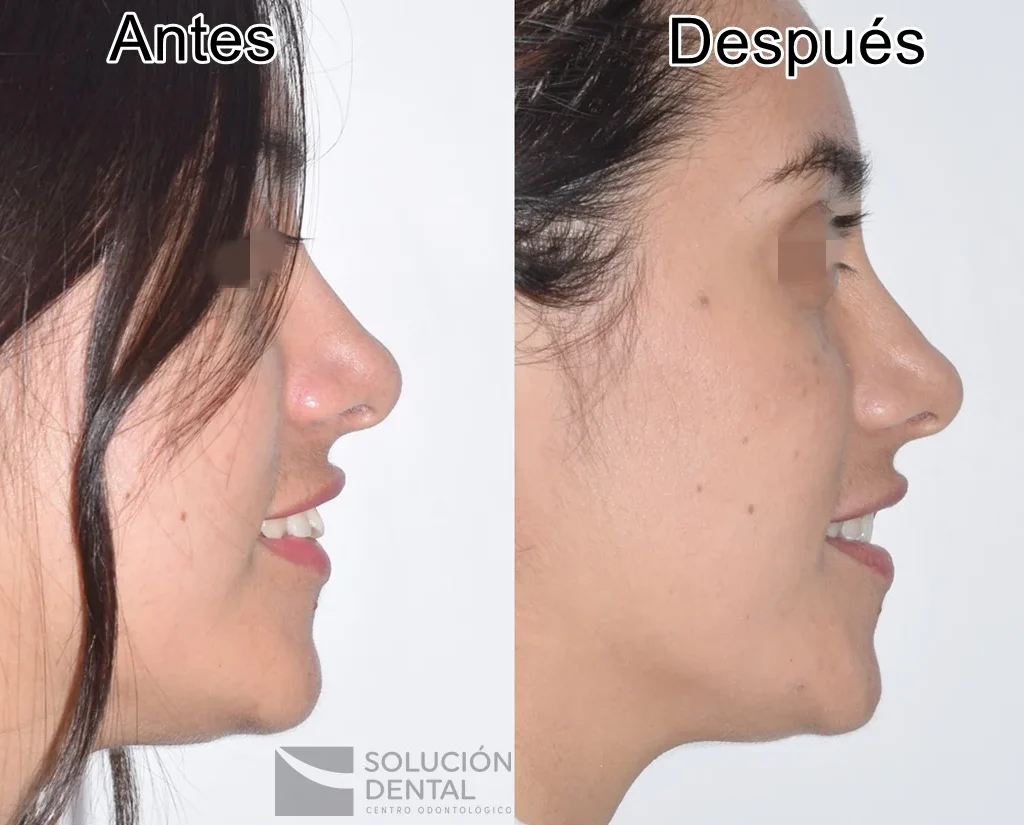 la-ortodoncia-cambia-la-forma-de-la-cara-fotos-antes-despues.