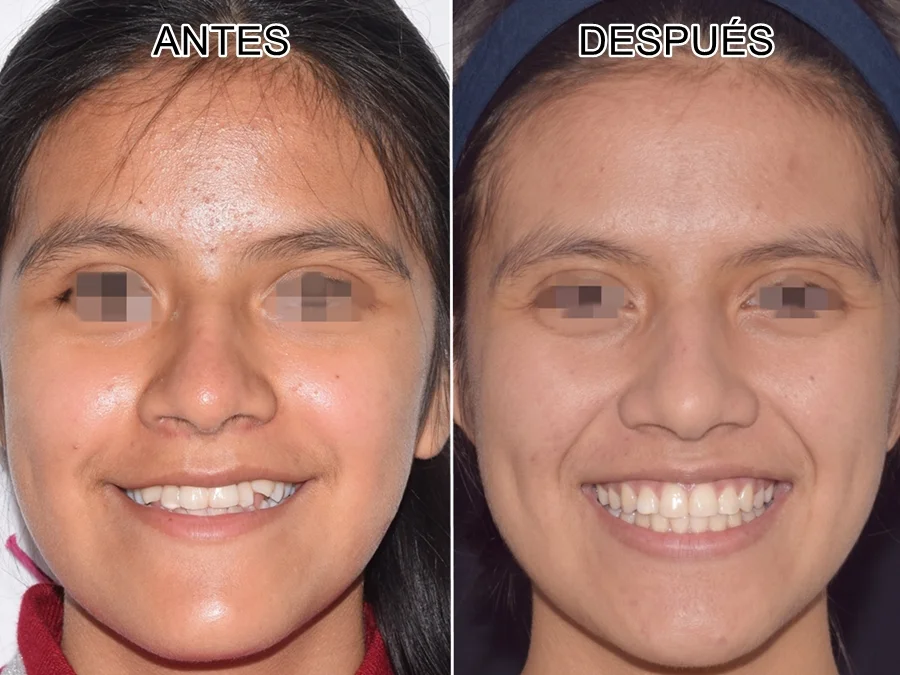 sonrisa FRONTAL comparativa expansion maxilar