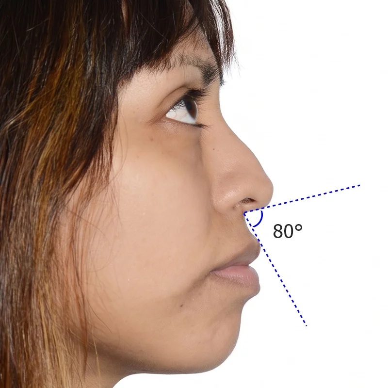 primero los brackets o la rinoplastia