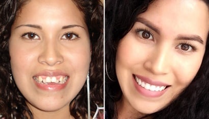 caso terminado de ortodoncia