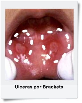 ulcera por brackets