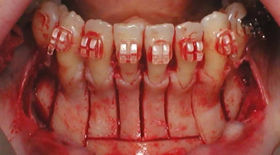 ortodoncia osteogénica acelerada