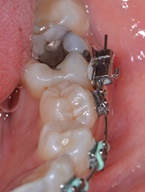 tubo de ortodoncia despegado