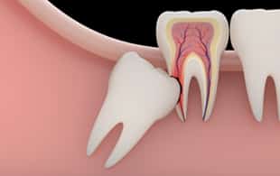 muelas del juicio en ortodoncia