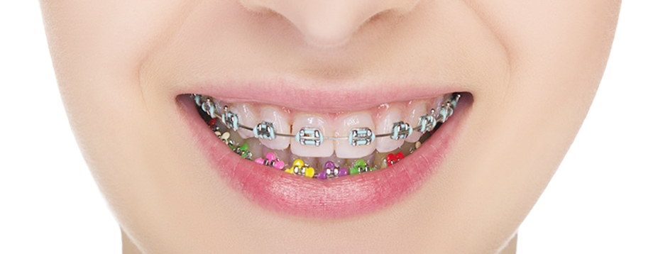 Brackets de colores, !Los divertidos¡ Solución Dental