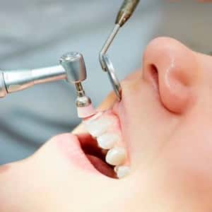 Limpieza profesional dental