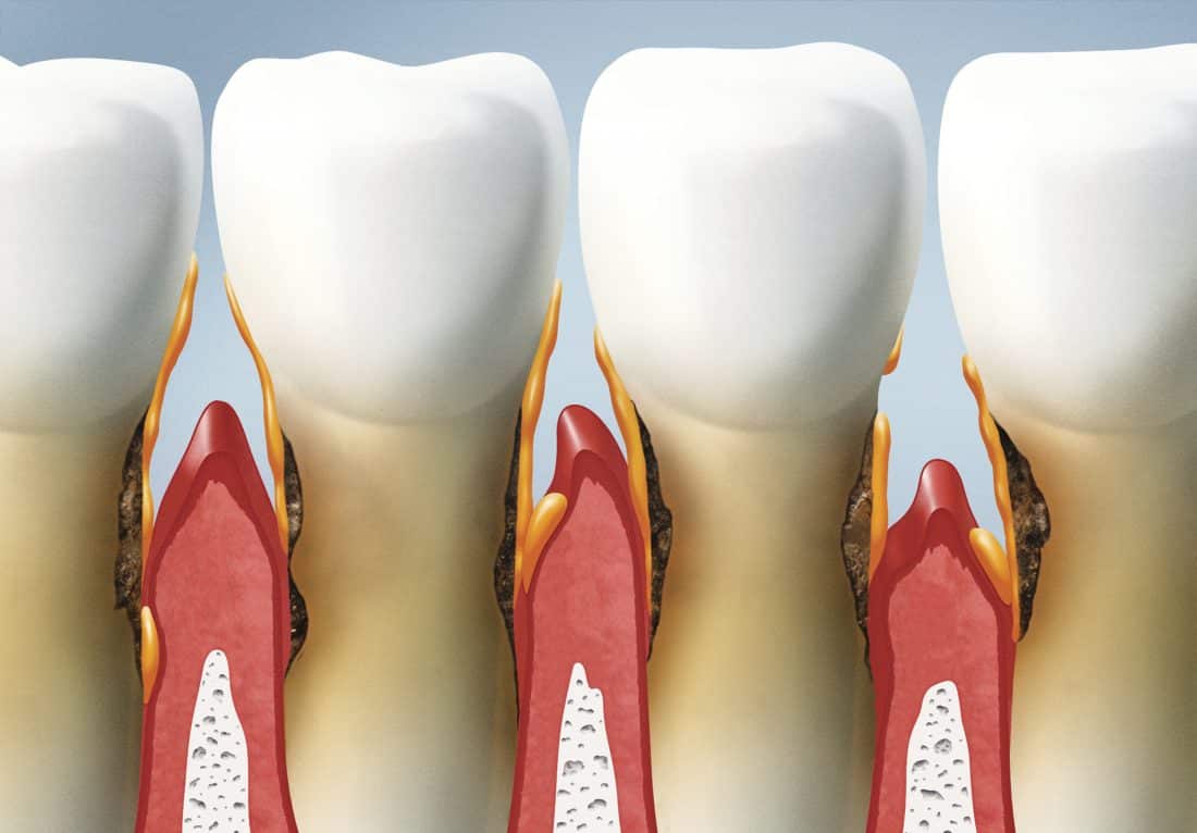 enfermedad de dientes y encias