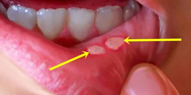 Heridas en la boca tratamiento
