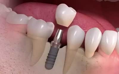 implante-dental sin dolor