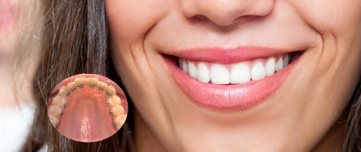 ventajas de la ortodoncia lingual