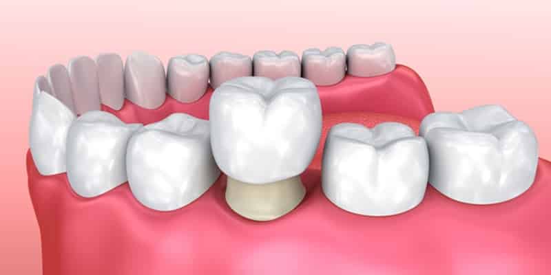 corona dental estética