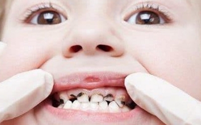 ortodoncia preventiva