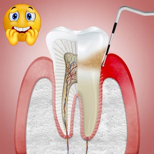 sondaje periodontal