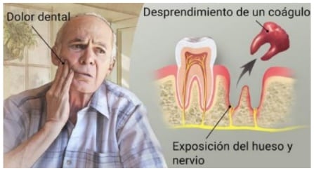 exposición del hueso alveolar dental