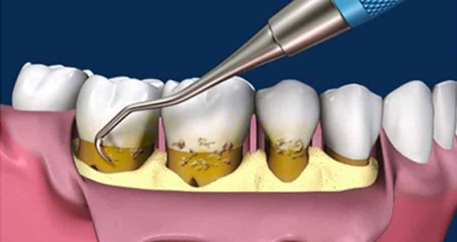 cirugia-periodontal-con-colgajo-y-curetaje