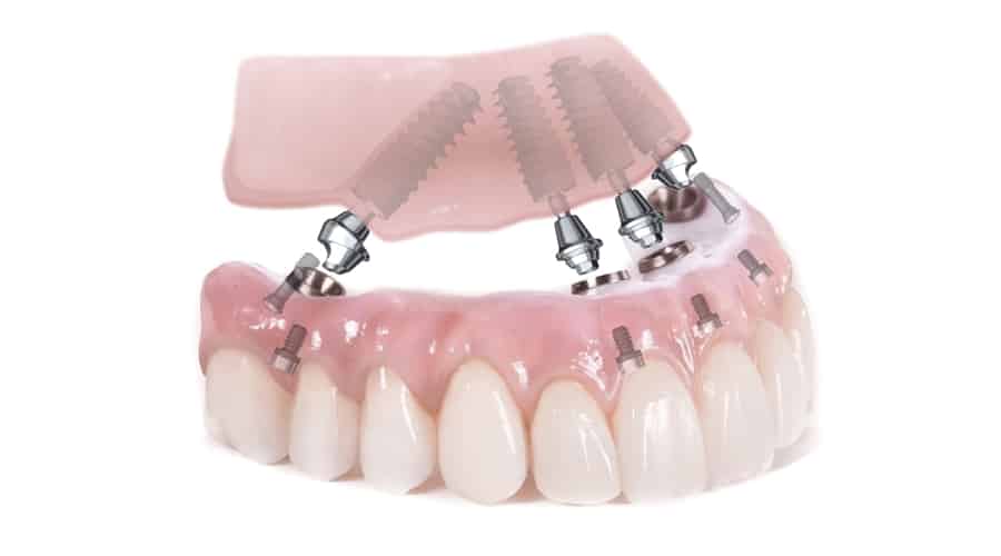 All-On-Four-implantes dentales con poco hueso