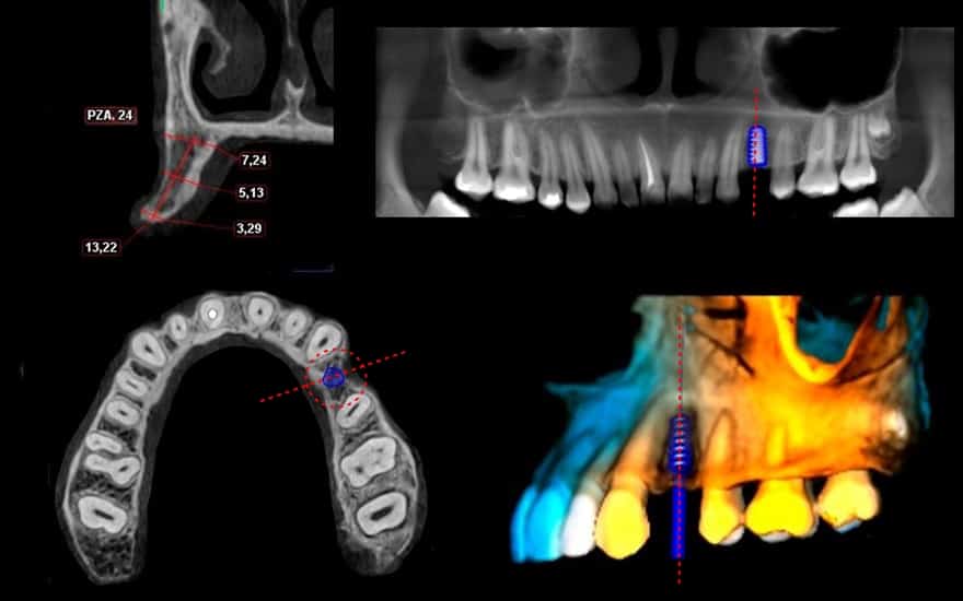 Tomografía CONE BEAM para implantes dentales