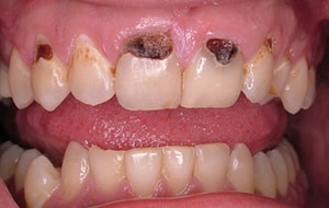 caries dental  radicular