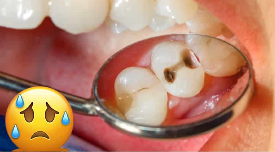 la temible caries dental