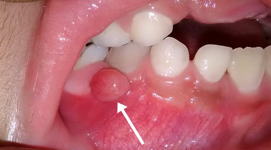 absceso dental requiere endodoncia