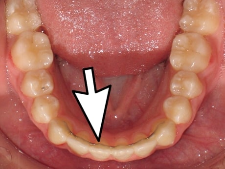 contención lingual ortodoncia