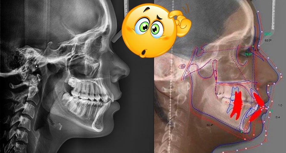 Radiografía cefalométrica o lateral estricta en ortodoncia