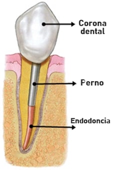 endodoncia poste y protesis dental