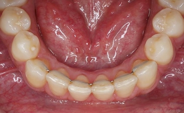 retenedor fijo ortodoncia