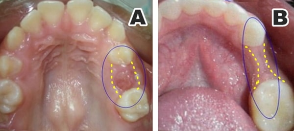 reabsorción osea de premolares para ortodoncia