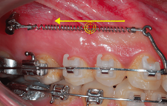 minitormnillo extraalveolar ortodoncia