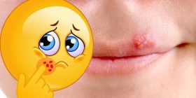 herpes labial y tratamiento actual