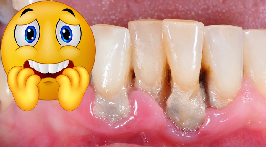 tipos de periodontitis