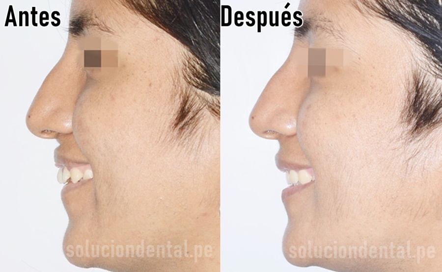 ortodoncia antes después en Lima Perú