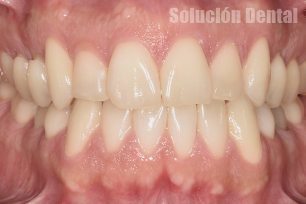 caso 1 ortodoncia lingual después