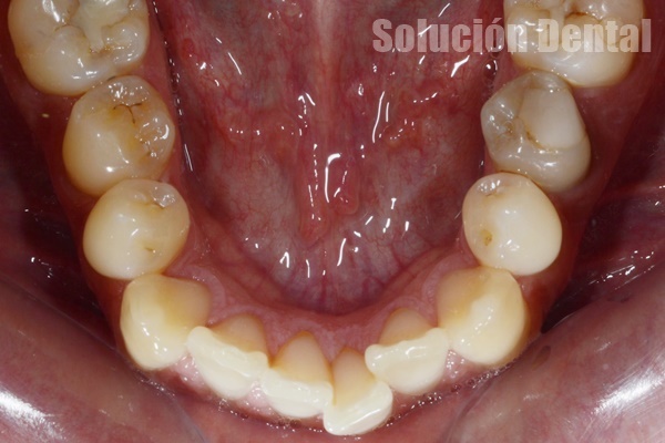 caso 1 ortodoncia lingual inferior