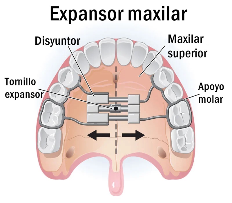 Expansor maxilar