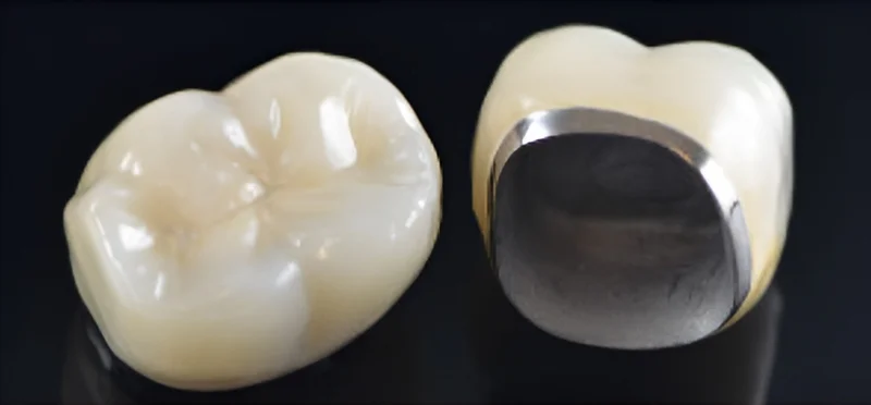 corona dental cuanto dura