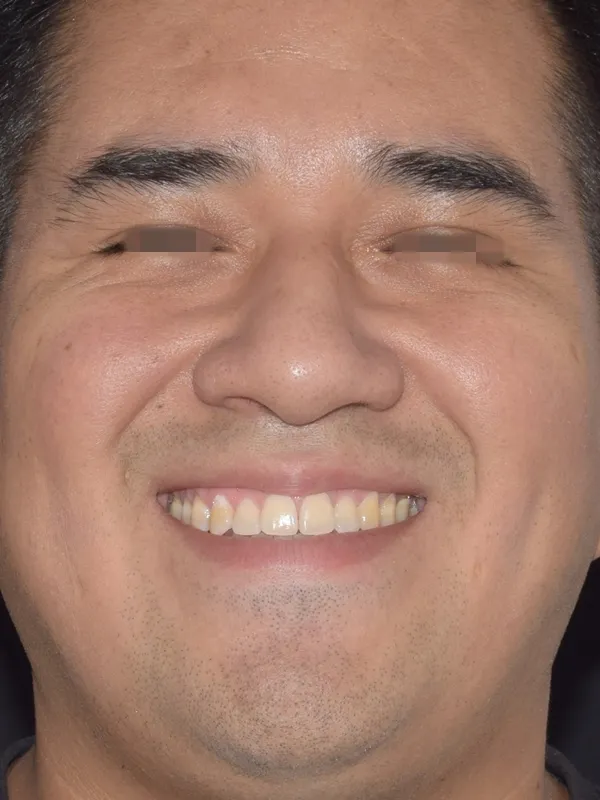despues de ortodoncia