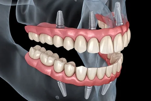 All-on-four-implante-dental-precio