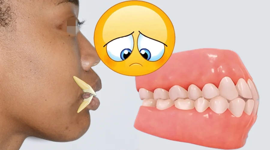 Biprotrusión dental
