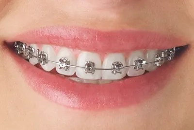 Brackets metálicos