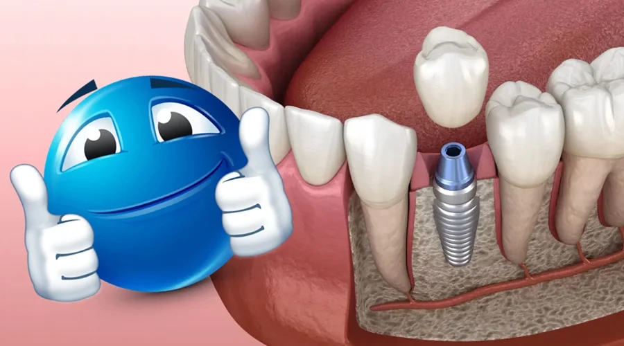 Cuánto cuesta un implante dental completo en Perú en 2025