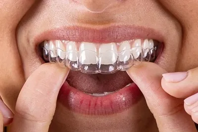 Invisalign